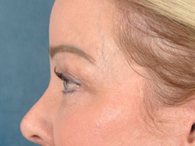 Eyelid Lift Before & After Gallery - Patient 256028 - Image 10