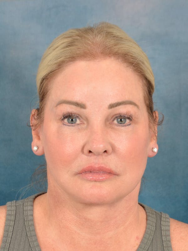 Deep Plane Facelift Before & After Gallery - Patient 142119 - Image 4