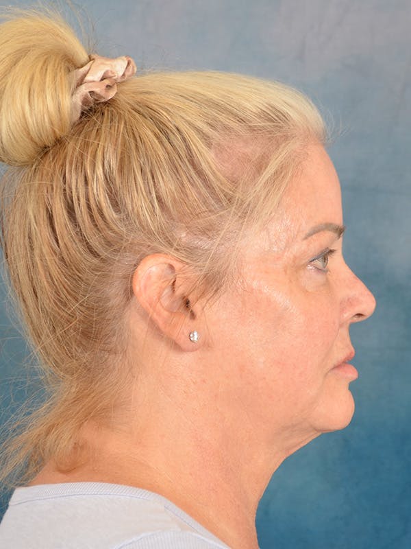 Deep Plane Facelift Before & After Gallery - Patient 142119 - Image 7