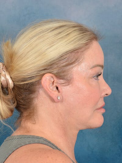 Deep Plane Facelift Before & After Gallery - Patient 142119 - Image 8