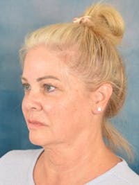 Deep Plane Facelift Before & After Gallery - Patient 329230 - Image 1