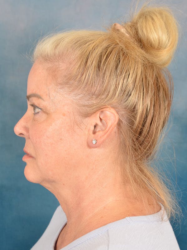 Deep Plane Facelift Before & After Gallery - Patient 142119 - Image 9