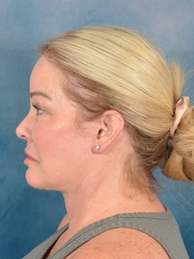 Deep Plane Facelift Before & After Gallery - Patient 142119 - Image 10