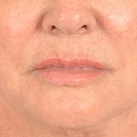 Lip Lift Before & After Gallery - Patient 390269 - Image 1