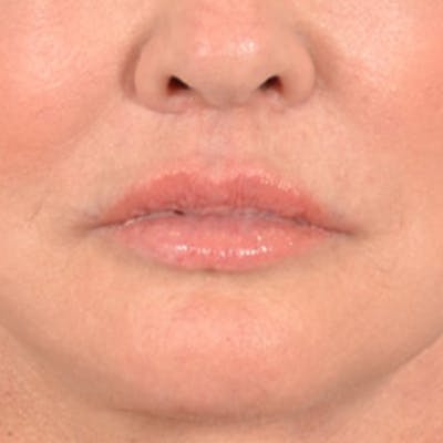 Lip Lift Before & After Gallery - Patient 390269 - Image 2
