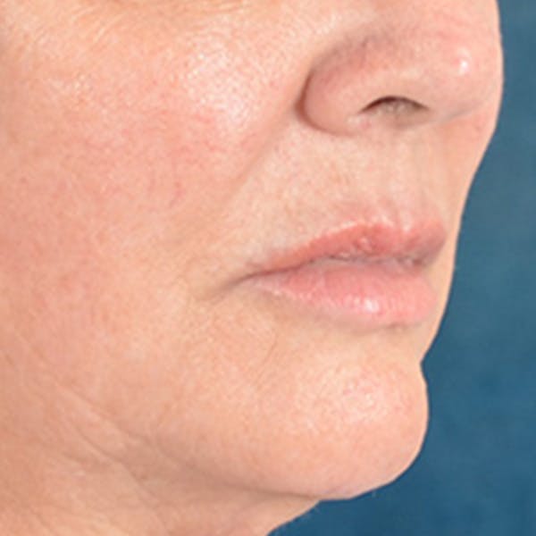 Lip Lift Before & After Gallery - Patient 390269 - Image 3