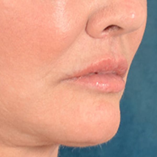 Lip Lift Before & After Gallery - Patient 390269 - Image 4