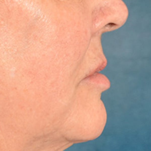 Lip Lift Before & After Gallery - Patient 390269 - Image 5