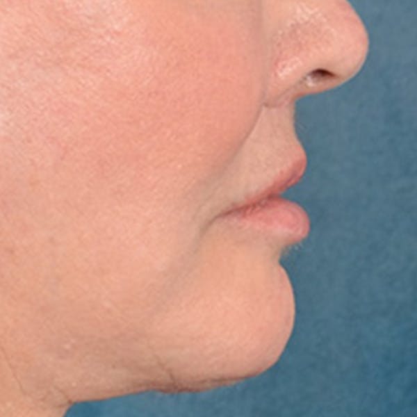 Lip Lift Before & After Gallery - Patient 390269 - Image 6