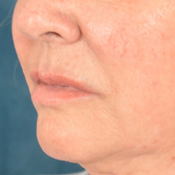 Lip Lift Before & After Gallery - Patient 390269 - Image 7