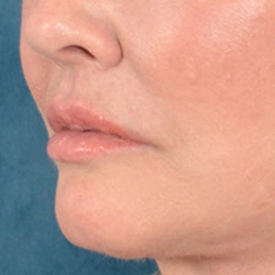 Lip Lift Before & After Gallery - Patient 390269 - Image 8