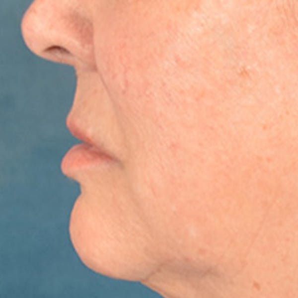 Lip Lift Before & After Gallery - Patient 390269 - Image 9