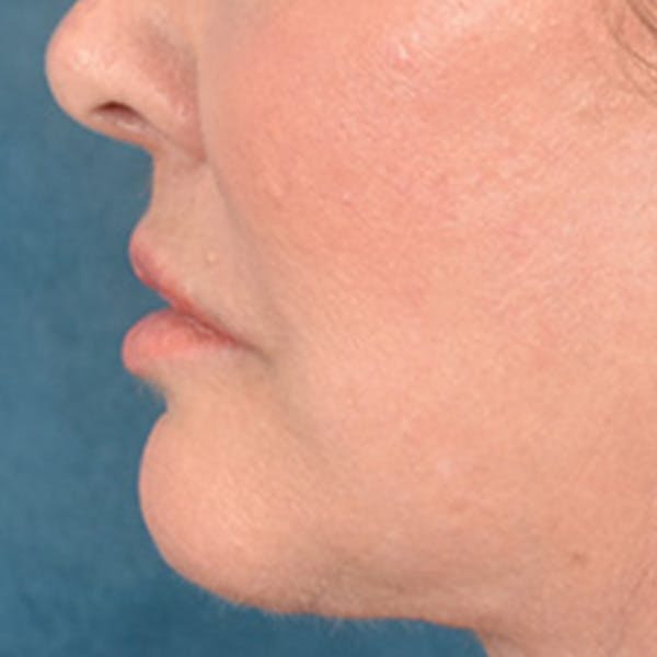 Lip Lift Before & After Gallery - Patient 390269 - Image 10