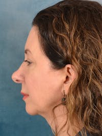 Rhinoplasty Before & After Gallery - Patient 275452 - Image 1