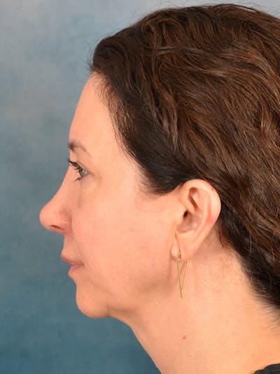 Rhinoplasty Before & After Gallery - Patient 275452 - Image 2