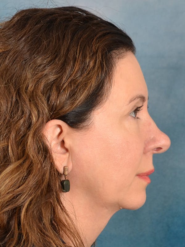 Rhinoplasty Before & After Gallery - Patient 275452 - Image 9