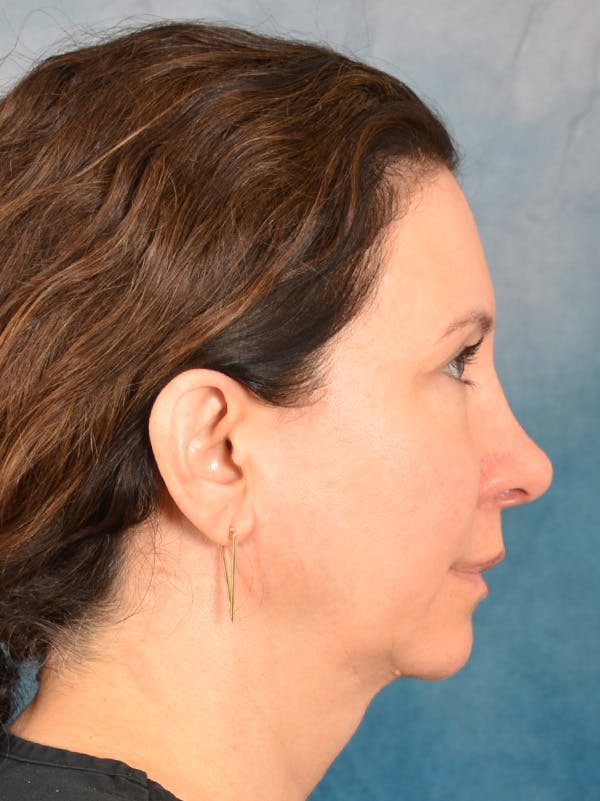 Rhinoplasty Before & After Gallery - Patient 275452 - Image 10