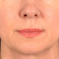 Lip Lift Before & After Gallery - Patient 409372 - Image 1