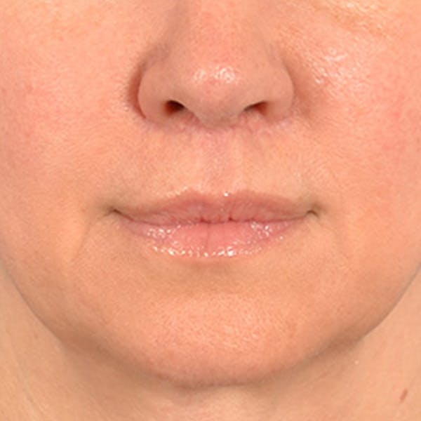 Lip Lift Before & After Gallery - Patient 409372 - Image 2