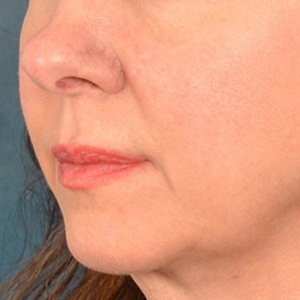 Lip Lift Before & After Gallery - Patient 409372 - Image 3