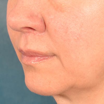 Lip Lift Before & After Gallery - Patient 409372 - Image 4