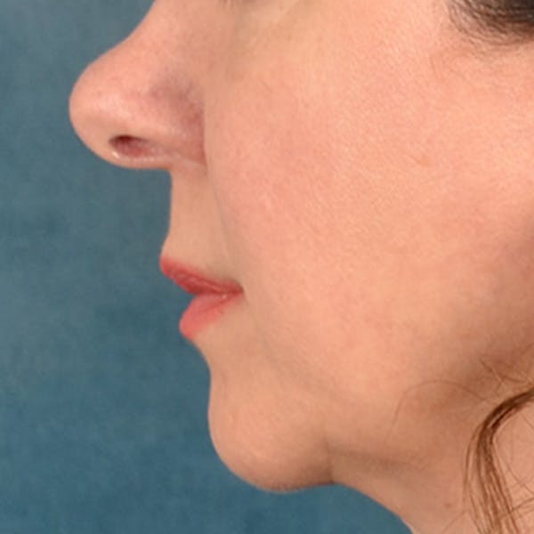 Lip Lift Before & After Gallery - Patient 409372 - Image 5