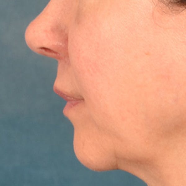 Lip Lift Before & After Gallery - Patient 409372 - Image 6