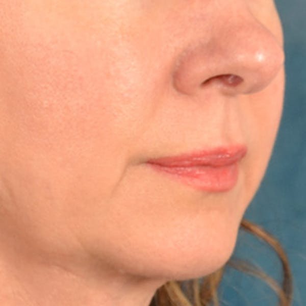 Lip Lift Before & After Gallery - Patient 409372 - Image 7