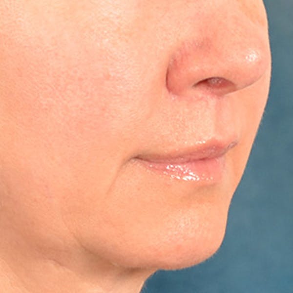 Lip Lift Before & After Gallery - Patient 409372 - Image 8