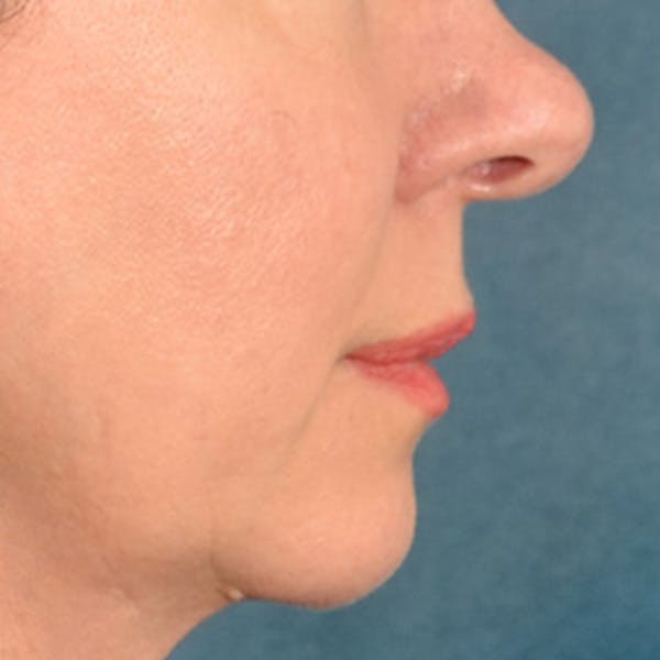 Lip Lift Before & After Gallery - Patient 409372 - Image 9