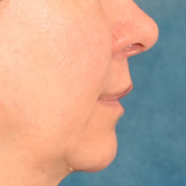 Lip Lift Before & After Gallery - Patient 409372 - Image 10