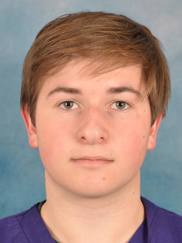 Rhinoplasty Before & After Gallery - Patient 535868 - Image 5