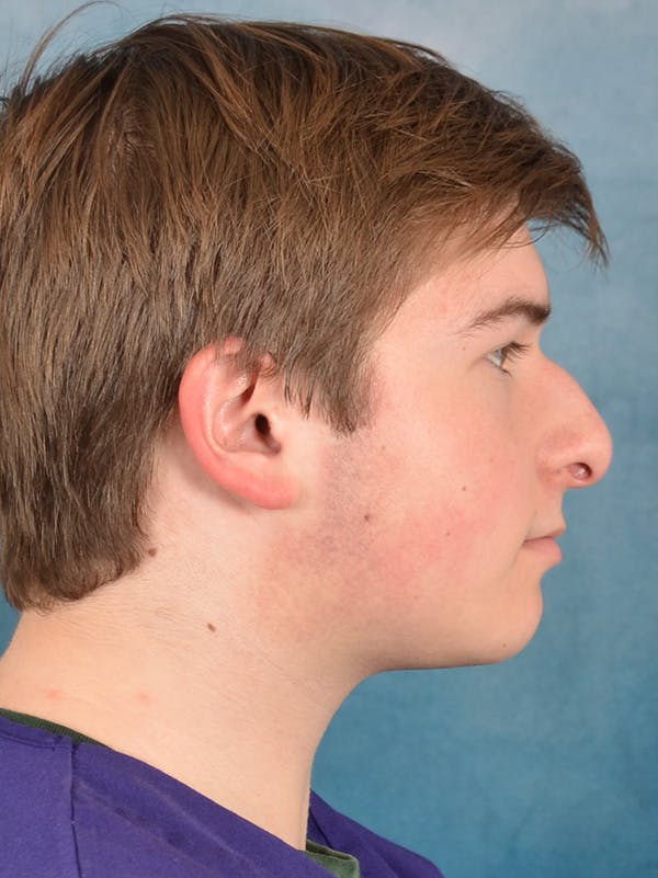 Rhinoplasty Before & After Gallery - Patient 535868 - Image 9