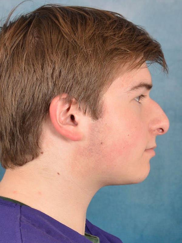 Rhinoplasty Before & After Gallery - Patient 403067 - Image 9
