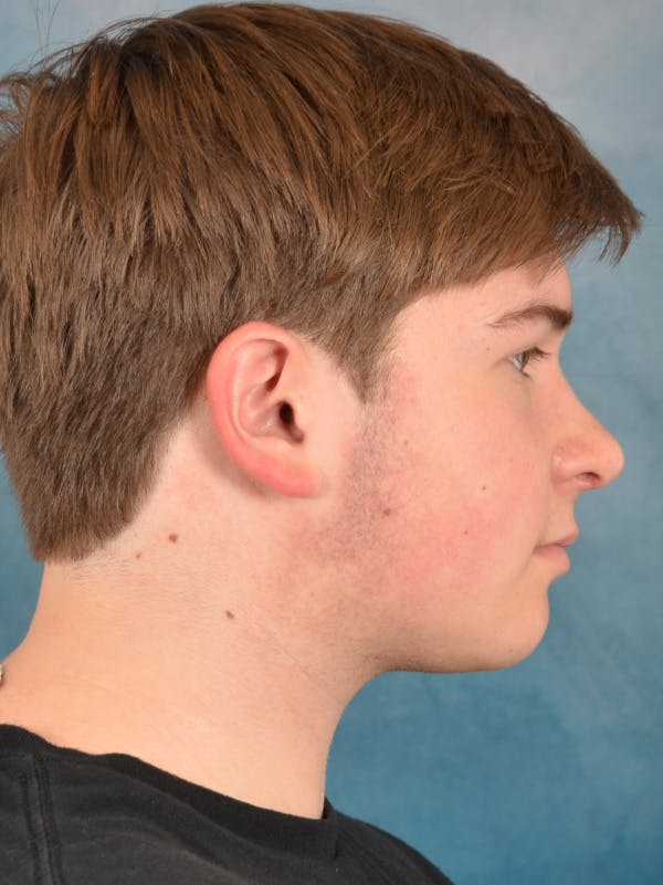 Rhinoplasty Before & After Gallery - Patient 535868 - Image 10
