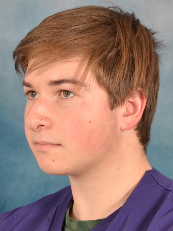 Rhinoplasty Before & After Gallery - Patient 535868 - Image 3