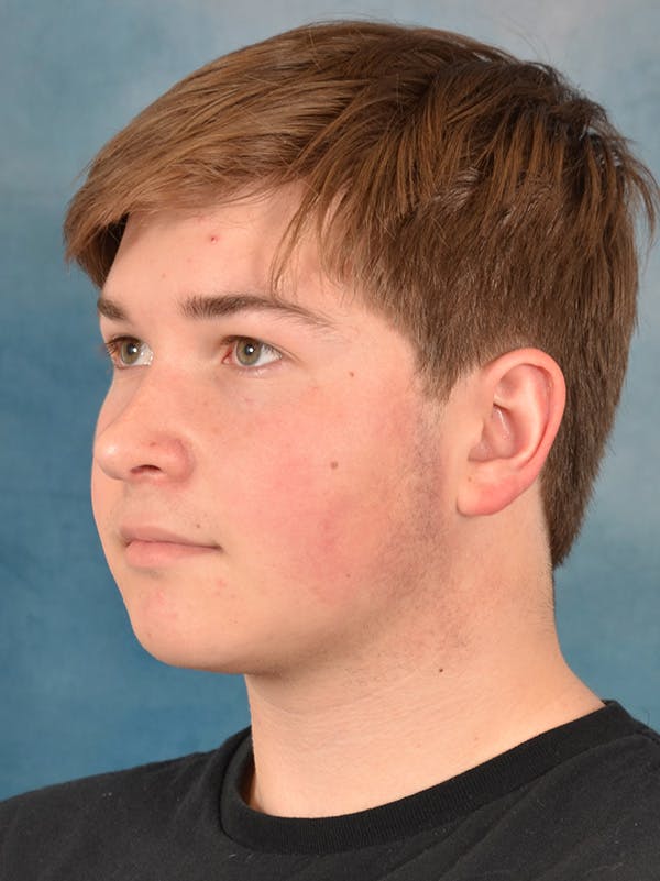 Rhinoplasty Before & After Gallery - Patient 535868 - Image 4
