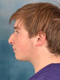 Rhinoplasty Before & After Gallery - Patient 535868 - Image 1