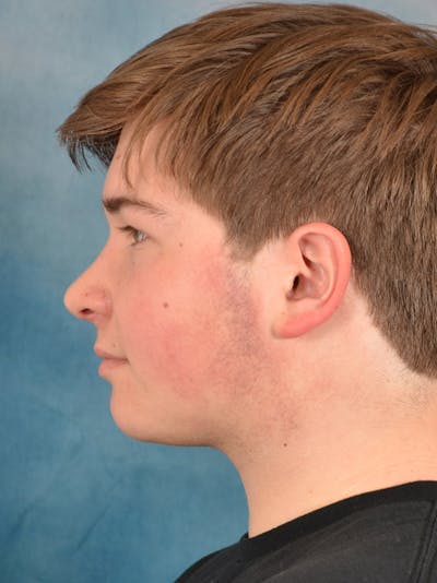 Rhinoplasty Before & After Gallery - Patient 535868 - Image 2