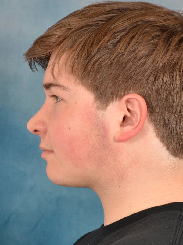 Rhinoplasty Before & After Gallery - Patient 535868 - Image 2