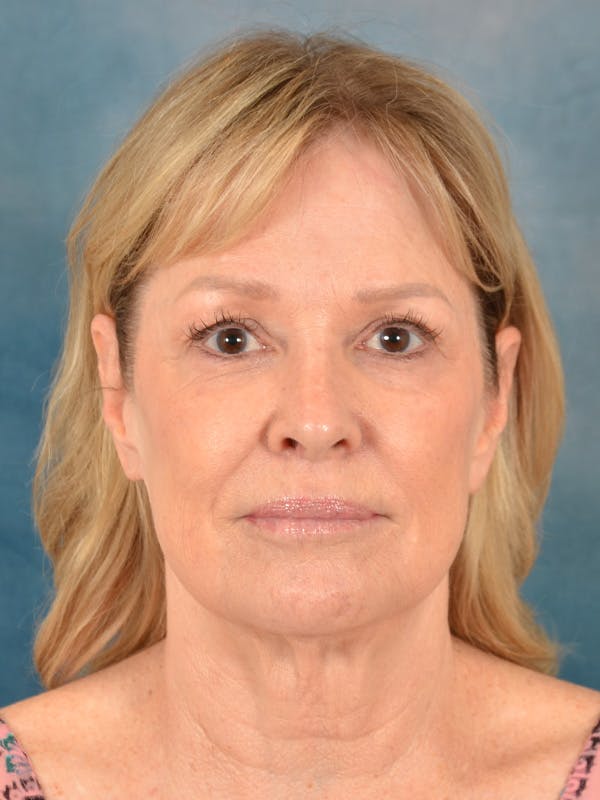 Deep Plane Facelift Before & After Gallery - Patient 329230 - Image 5
