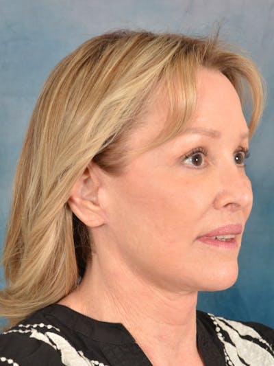 Laser Skin Resurfacing Before & After Gallery - Patient 389743 - Image 8