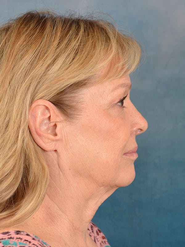 Laser Skin Resurfacing Before & After Gallery - Patient 389743 - Image 9