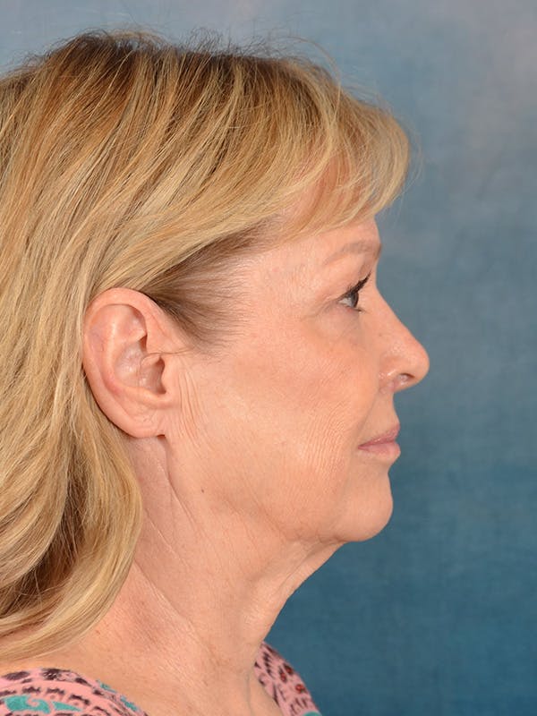 Deep Plane Facelift Before & After Gallery - Patient 329230 - Image 9