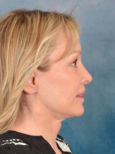 Laser Skin Resurfacing Before & After Gallery - Patient 389743 - Image 10