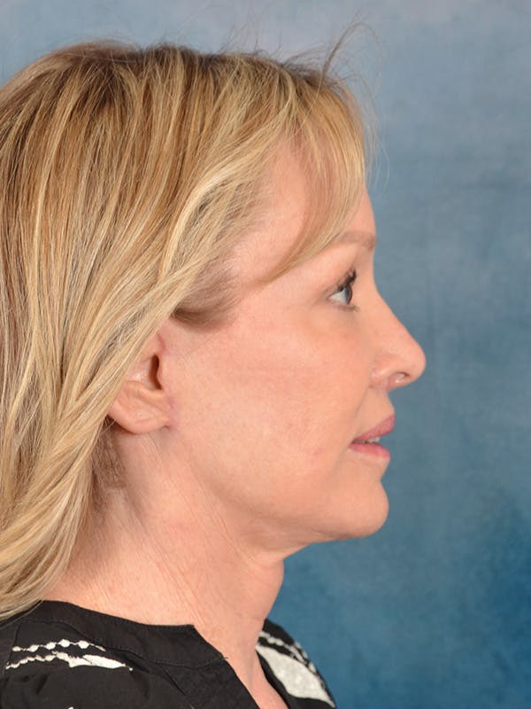 Deep Plane Facelift Before & After Gallery - Patient 329230 - Image 10
