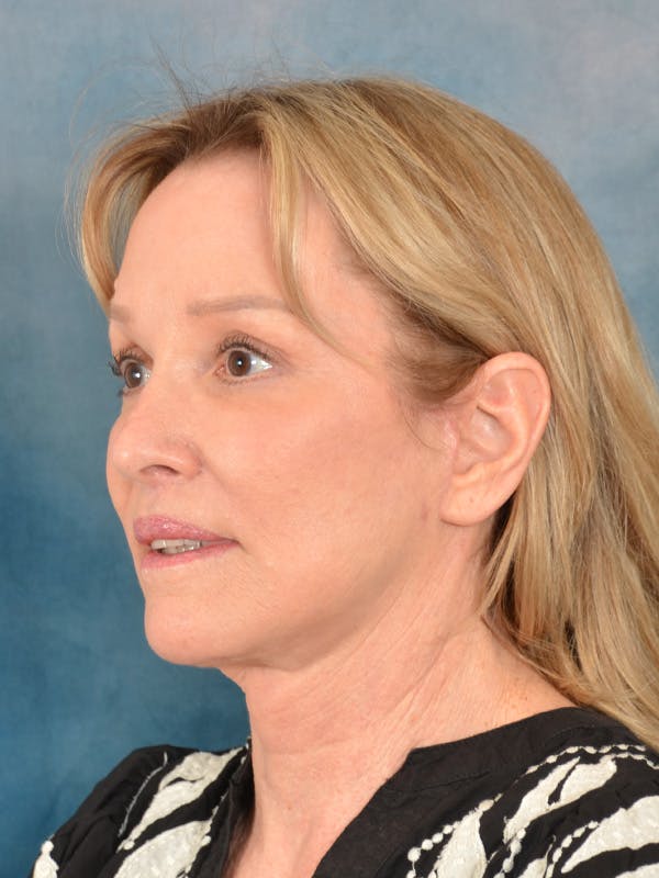 Laser Skin Resurfacing Before & After Gallery - Patient 389743 - Image 4