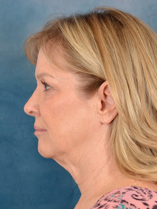 Laser Skin Resurfacing Before & After Gallery - Patient 389743 - Image 5