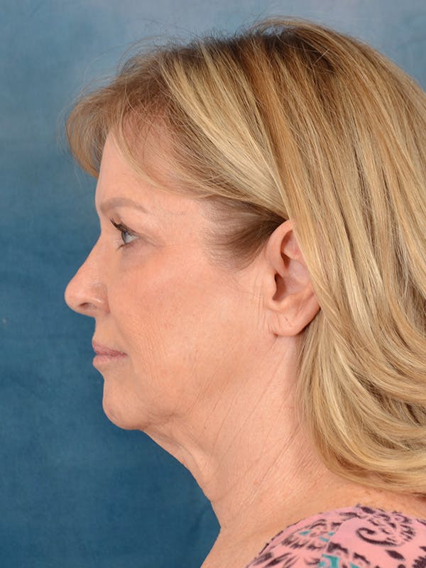 Deep Plane Facelift Before & After Gallery - Patient 329230 - Image 3