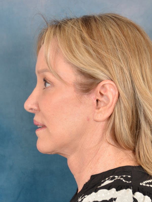 Deep Plane Facelift Before & After Gallery - Patient 329230 - Image 4